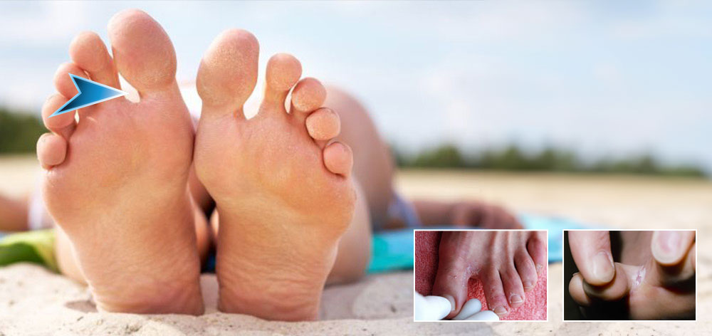 signs of athlete’s foot